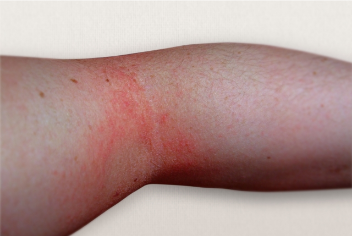 アトピー性皮膚炎 | 新宿区 おうえケアとわクリニック