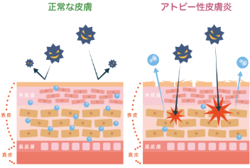 アトピー性皮膚炎の悪化原因 | 新宿区 おうえケアとわクリニック